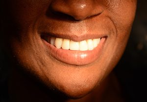 Woman’s teeth, after Dental Crowns treatment, front view - patient 6