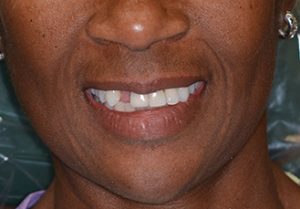 Woman’s teeth, before Dental Crowns treatment, front view - patient 6