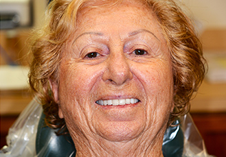 Woman’s teeth, after Dental Crowns treatment, front view - patient 7