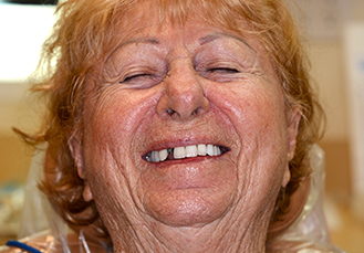 Woman’s teeth, before Dental Crowns treatment, front view - patient 7