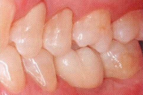 Patient teeth, after Dental Implants treatment, front view - patient 2