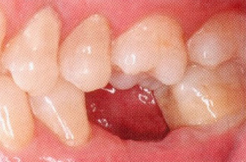 Patient teeth, before Dental Implants treatment, front view - patient 2