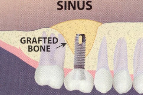 Patient teeth, after Dental Implants (Sinus Lift to Accommodate Implant) treatment, front view - patient 3