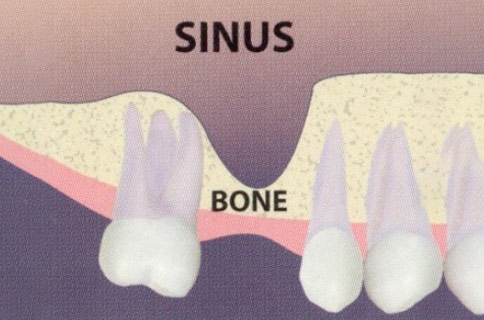 Patient teeth, before Dental Implants (Sinus Lift to Accommodate Implant) treatment, front view - patient 3