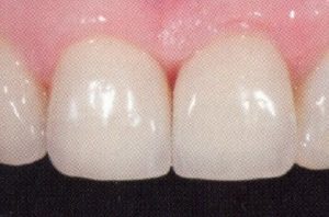 Patient teeth, after Dental Implants treatment, front view - patient 4