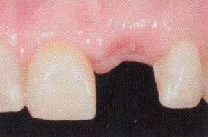 Patient teeth, before Dental Implants treatment, front view - patient 4