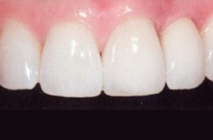 Patient teeth, after Dental Implants treatment, front view - patient 5