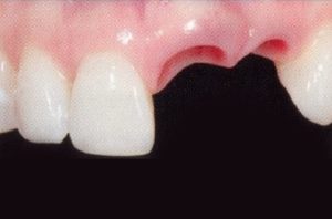 Patient teeth, before Dental Implants treatment, front view - patient 5