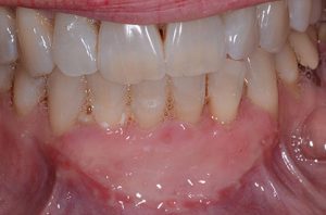 Patient teeth, after Gum Rejuvenation treatment, front view - patient 1