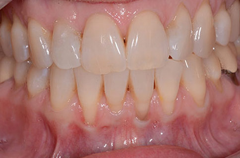 Patient teeth, before Gum Rejuvenation treatment, front view - patient 1