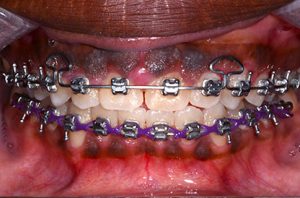 Patient teeth, after Gum Rejuvenation treatment, front view - patient 2