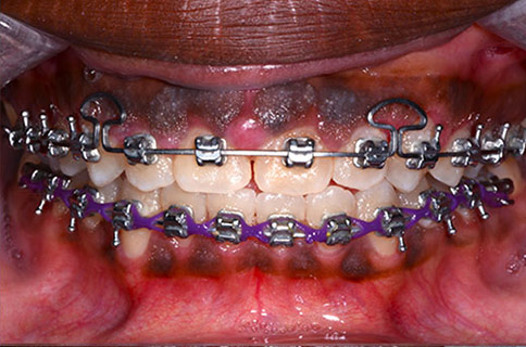 Patient teeth, after Gum Rejuvenation treatment, front view - patient 2