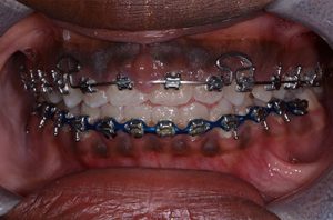 Patient teeth, before Gum Rejuvenation treatment, front view - patient 2