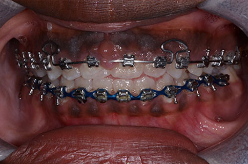 Patient teeth, before Gum Rejuvenation treatment, front view - patient 2