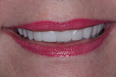 Patient teeth, after Smile Restoration treatment, front view - patient 4