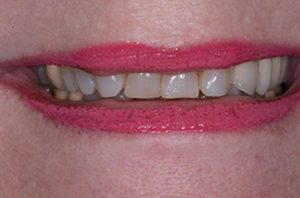 Patient teeth, before Smile Restoration treatment, front view - patient 4