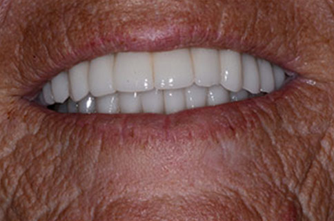 Patient teeth, after Smile Restoration treatment, front view - patient 5