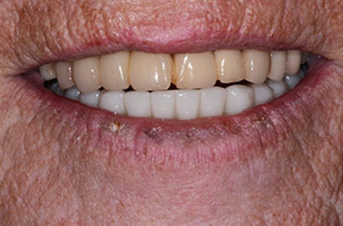 Patient teeth, before Smile Restoration treatment, front view - patient 5