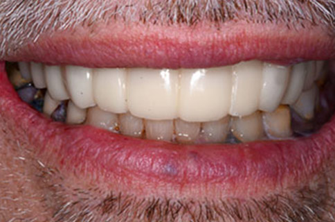 Patient teeth, after Smile Restoration treatment, front view - patient 2