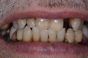 Patient teeth, before Smile Restoration treatment, front view - patient 2