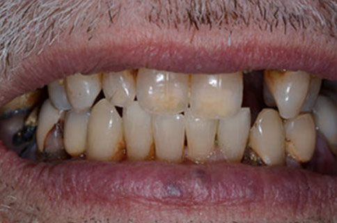 Patient teeth, before Smile Restoration treatment, front view - patient 2