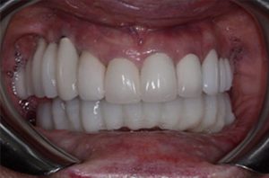 Patient teeth, after Smile Restoration treatment, front view - patient 3