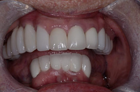 Patient teeth, before Smile Restoration treatment, front view - patient 3