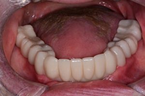 Patient teeth, after Smile Restoration treatment, front view - patient 1