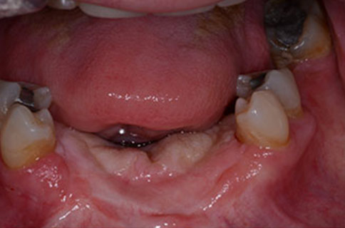 Patient teeth, before Smile Restoration treatment, front view - patient 1