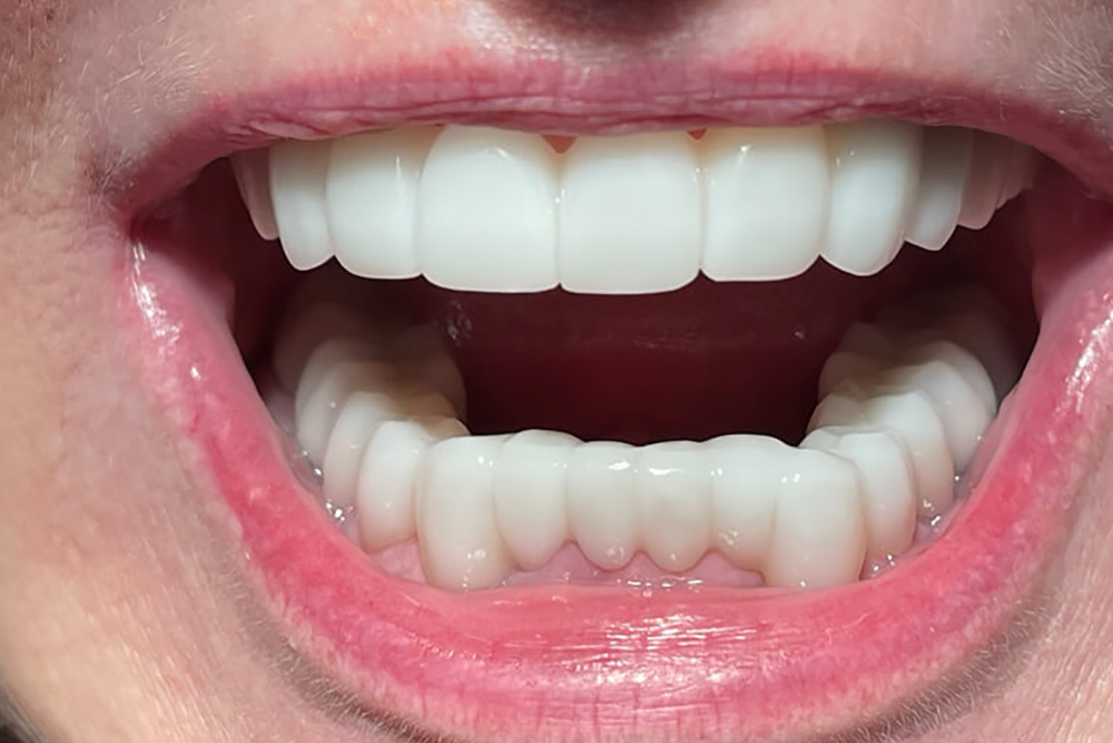 Patient teeth after treatment at Boca’s Leader in Periodontics (front view)