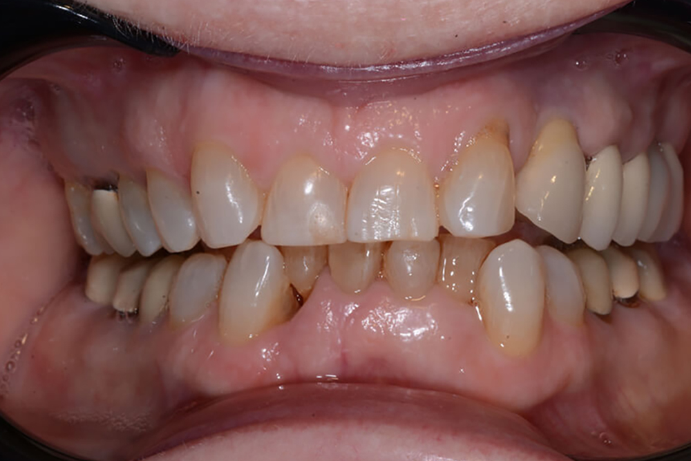 Patient teeth before treatment at Boca’s Leader in Periodontics (front view)