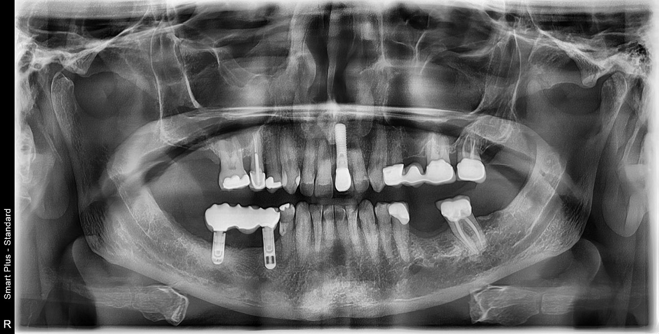 Condemned Implant Bridge Preservation Via Implant Decontamination/Bone Reconstruction.