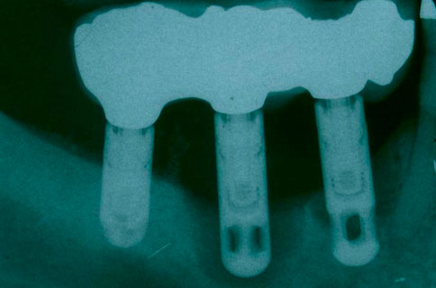 Condemned Implant Bridge Preservation Via Implant Decontamination/Bone Reconstruction.