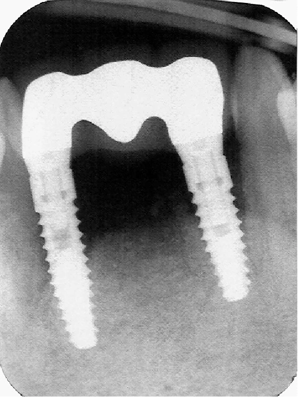 Condemned Implant Bridge Preservation Via Implant Decontamination/Bone Reconstruction.