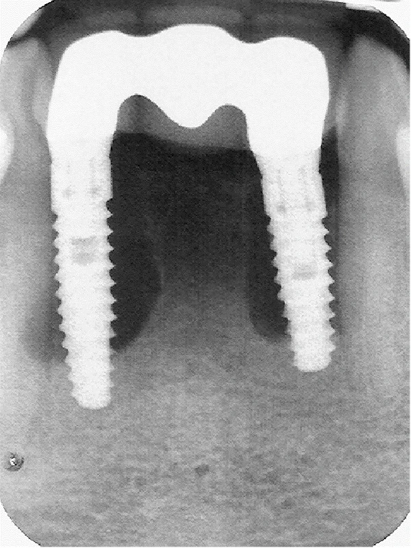 Condemned Implant Bridge Preservation Via Implant Decontamination/Bone Reconstruction.