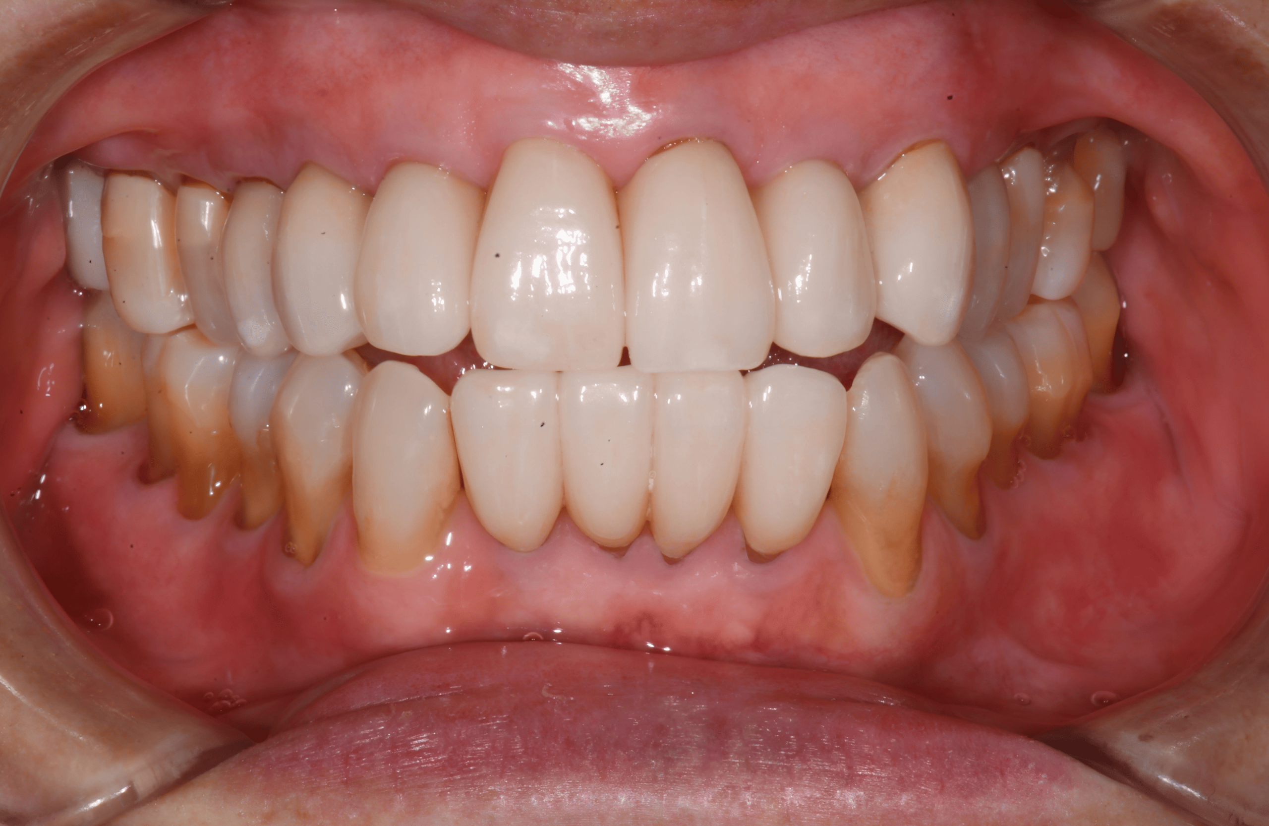 Patient teeth, after Gum Rejuvenation treatment, front view - patient 4