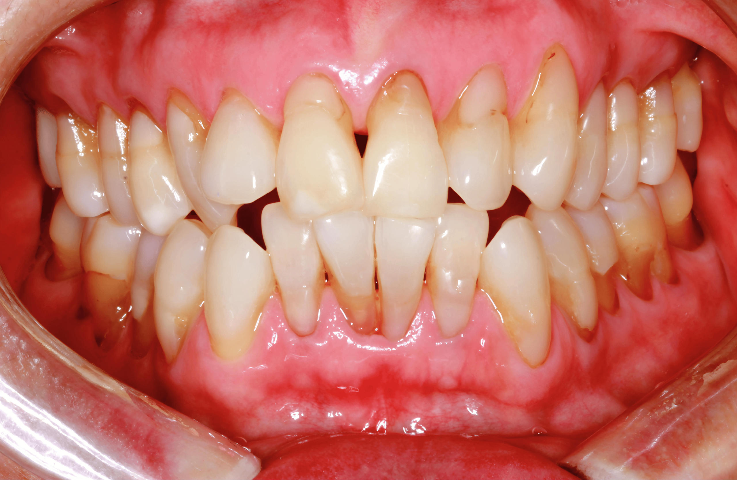 Patient teeth, before Gum Rejuvenation treatment, front view - patient 4