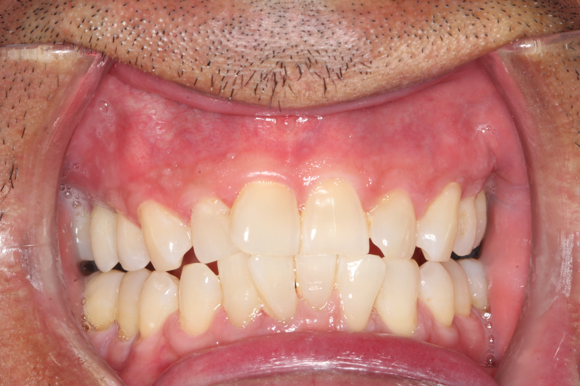 After patient 12