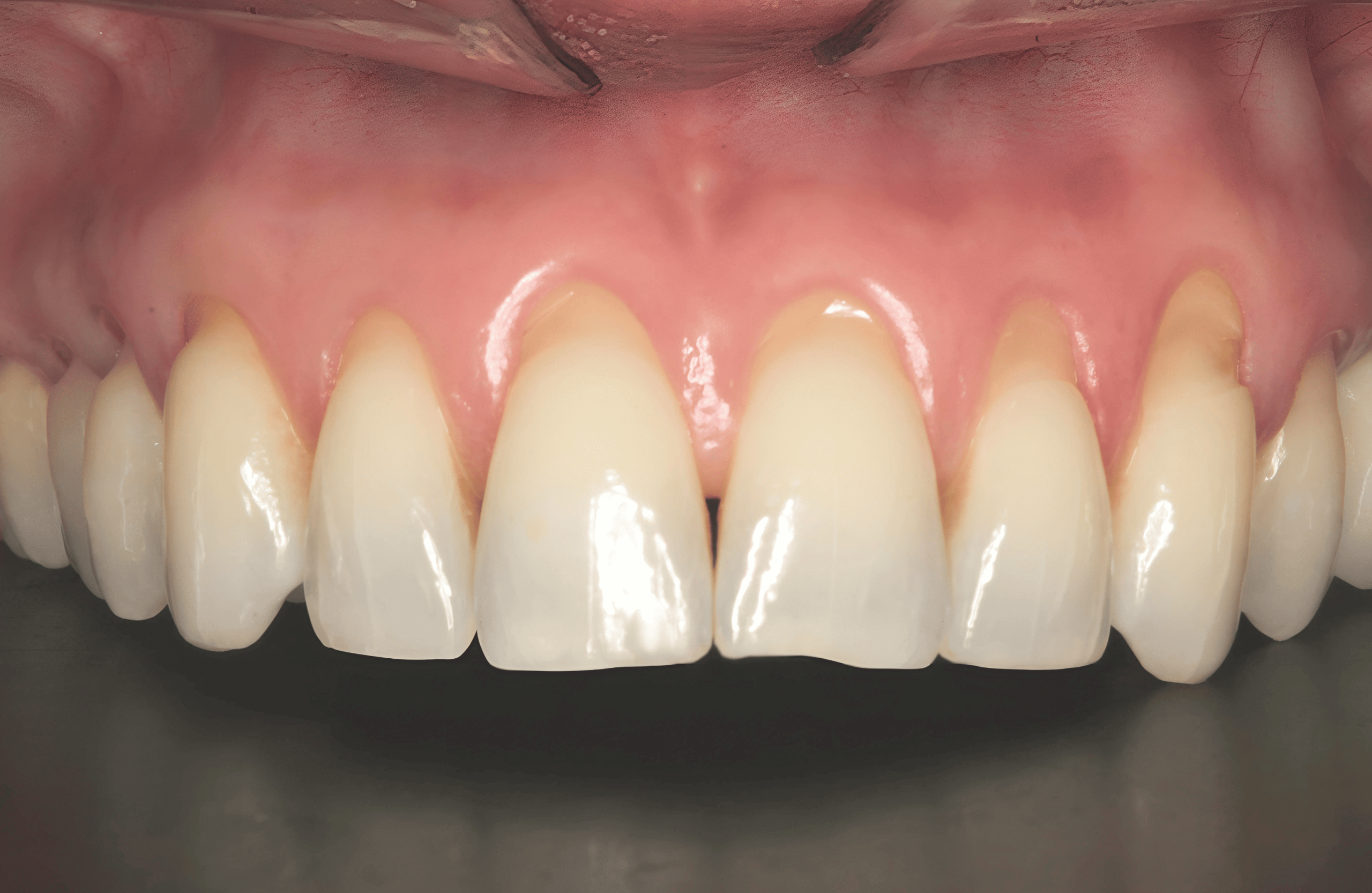 Patient teeth, before Gum Rejuvenation treatment, front view - patient 5