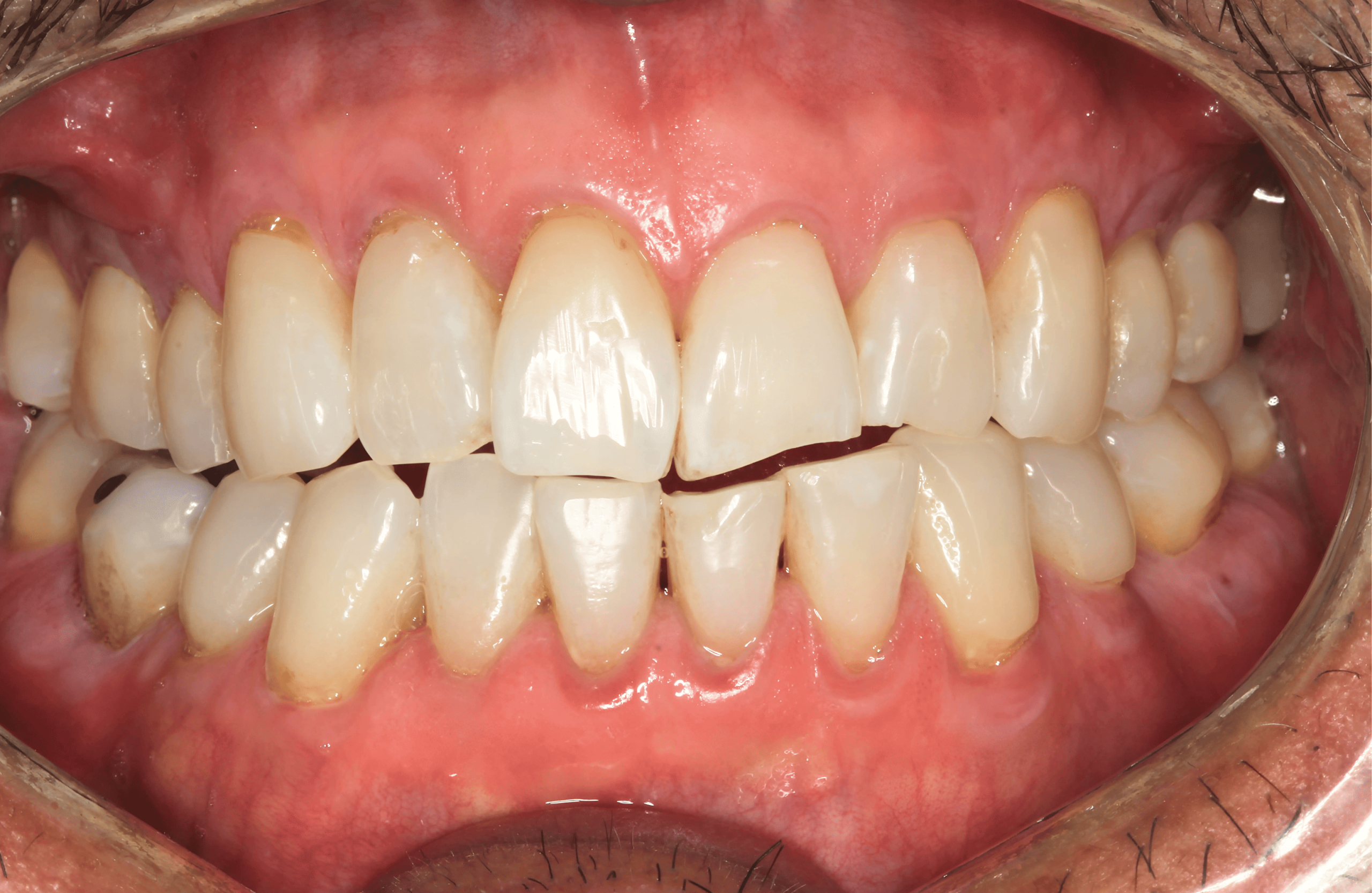 Patient teeth, after Gum Rejuvenation treatment, front view - patient 4