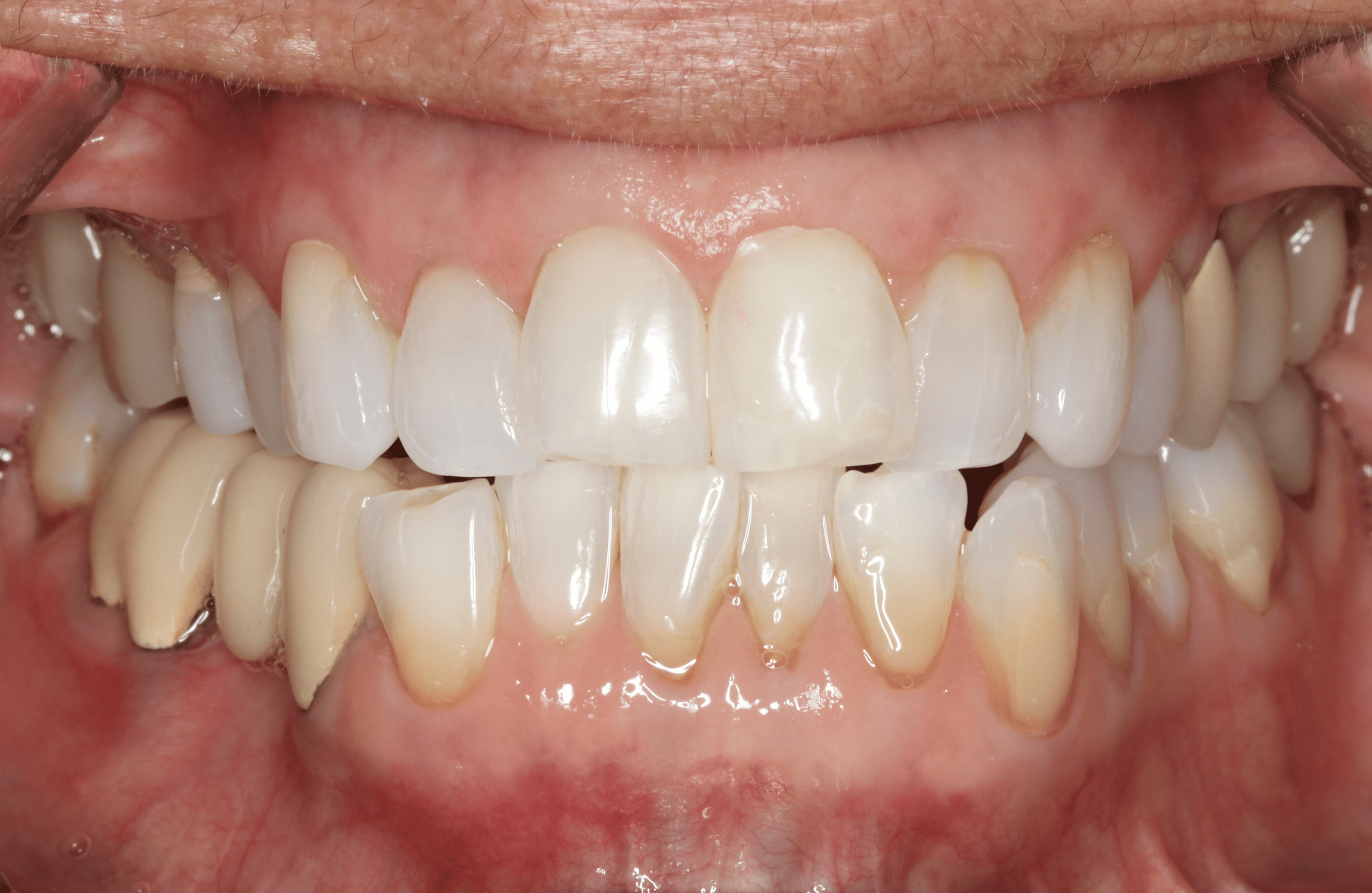 Patient teeth, before Gum Rejuvenation treatment, front view - patient 5