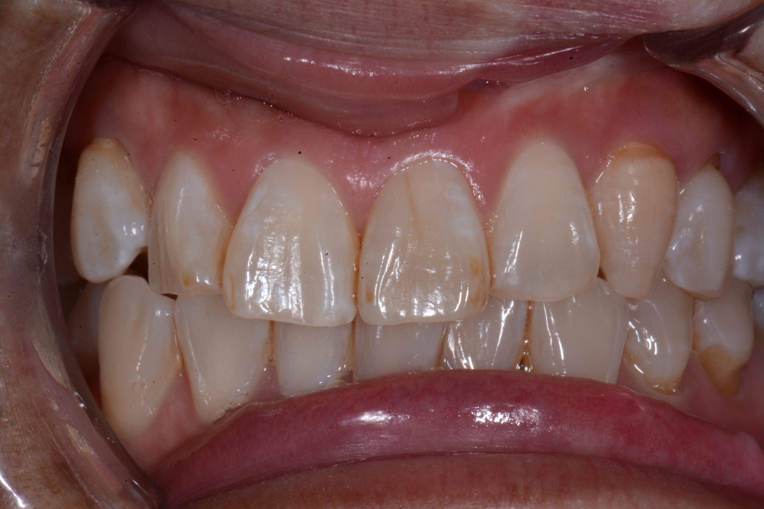 After patient 6