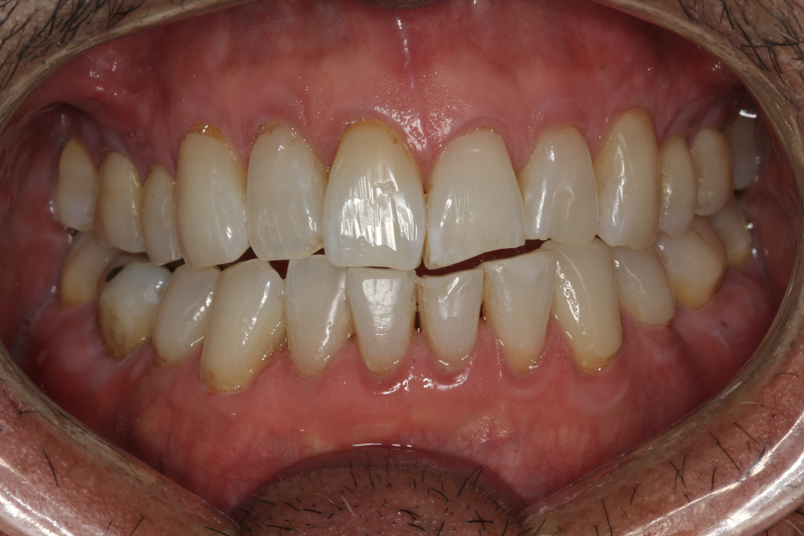 After patient 9