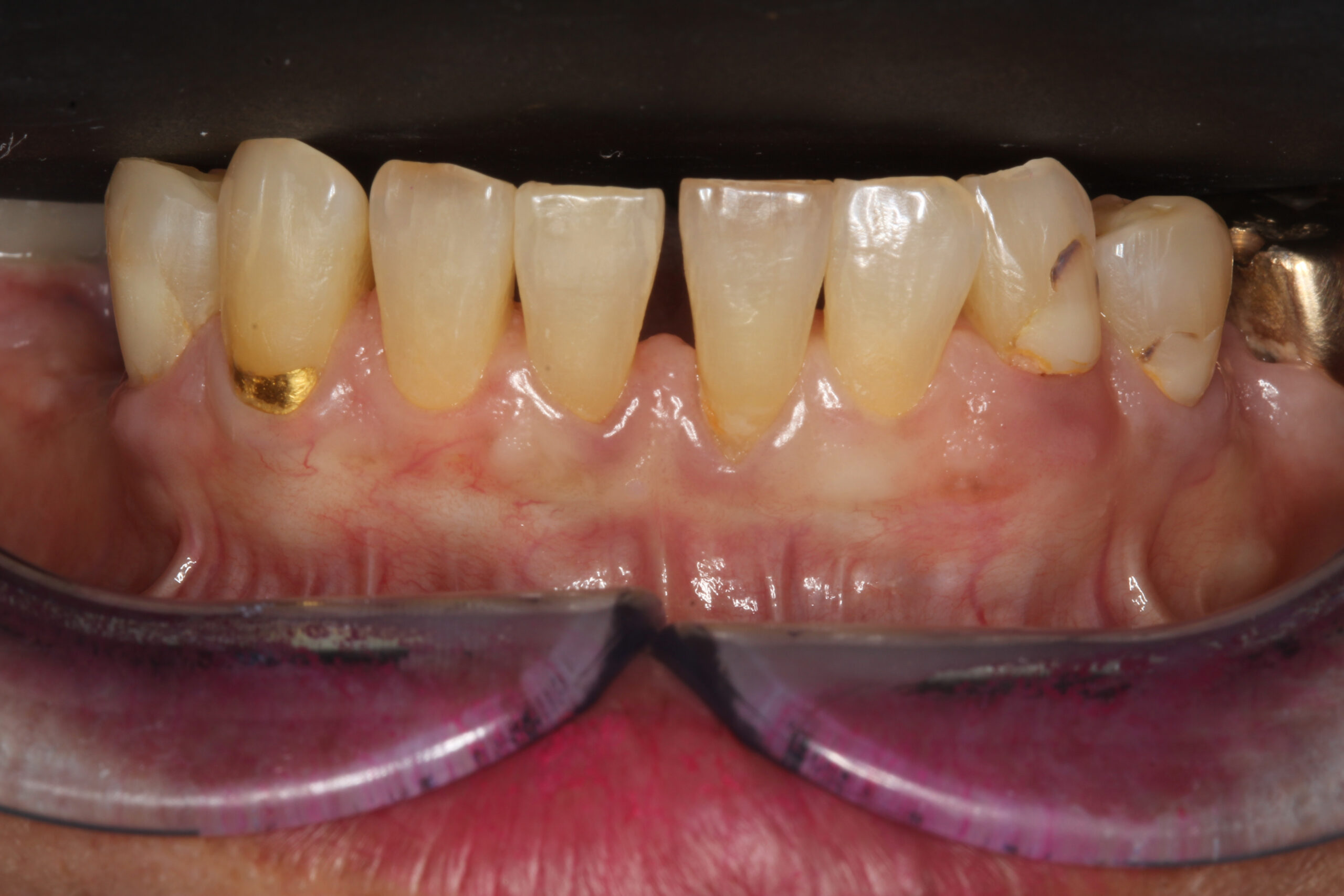 After patient 10